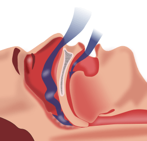 The link between sleep apnea and weight loss